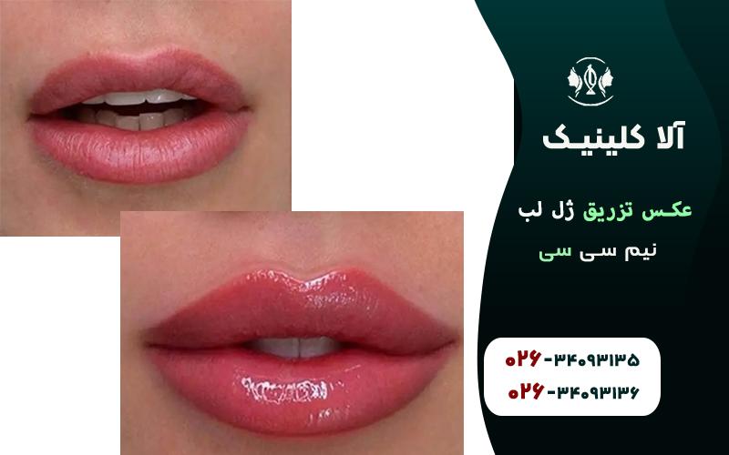 تزریق ژل لب نیم سی سی