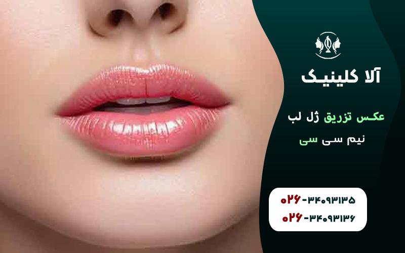 عکس تزریق ژل لب نیم سی سی