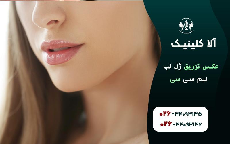 عکس تزریق ژل لب نیم سی سی