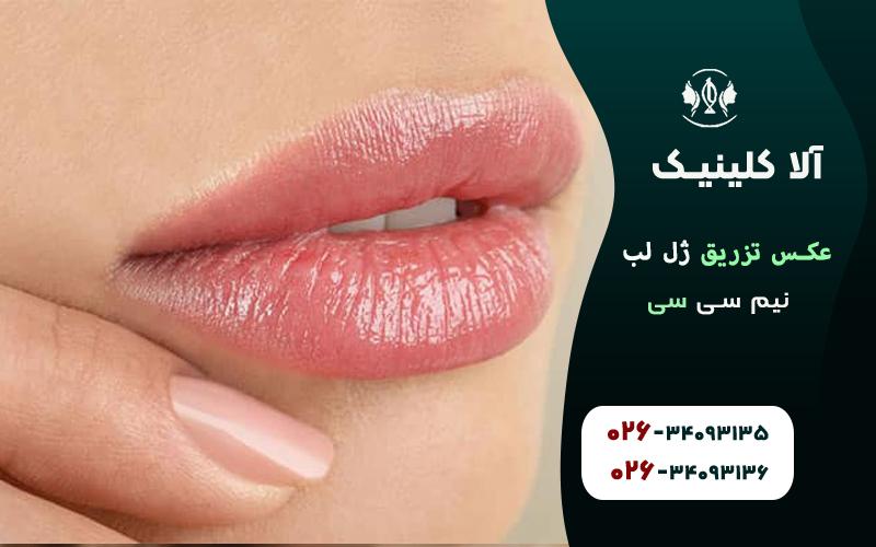 عکس تزریق ژل لب نیم سی سی