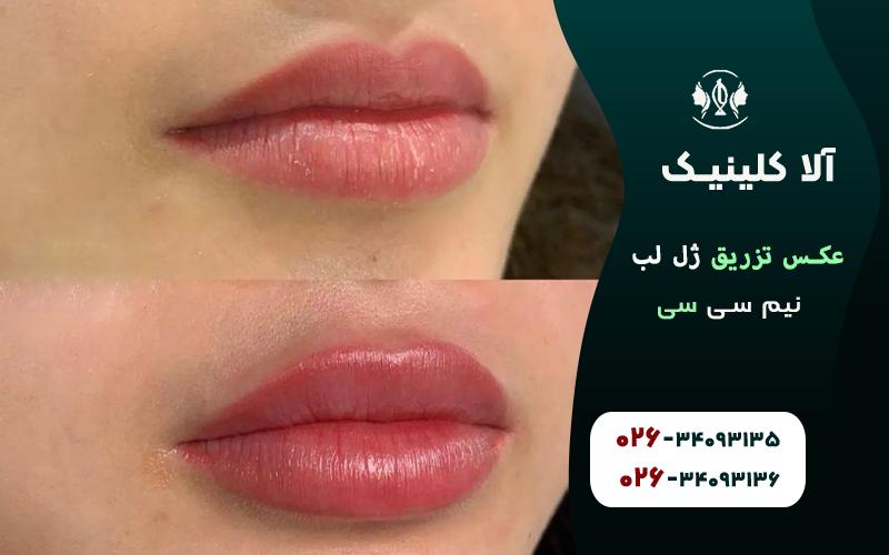 عکس تزریق ژل لب نیم سی سی