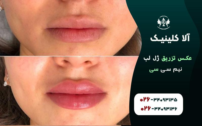 عکس تزریق ژل لب نیم سی سی قبل و بعد
