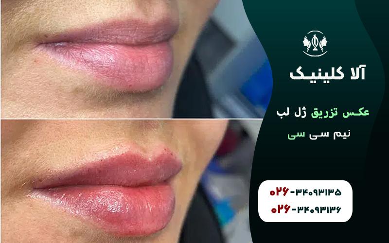 عکس قبل و بعد از تزریق ژل لب نیم سی سی