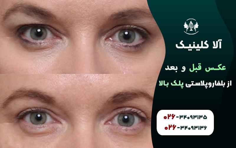 عکس قبل و بعد از بلفاروپلاستی پلک بالا