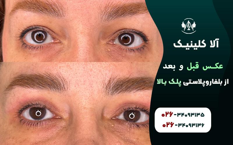 عکس قبل و بعد از بلفاروپلاستی پلک بالا
