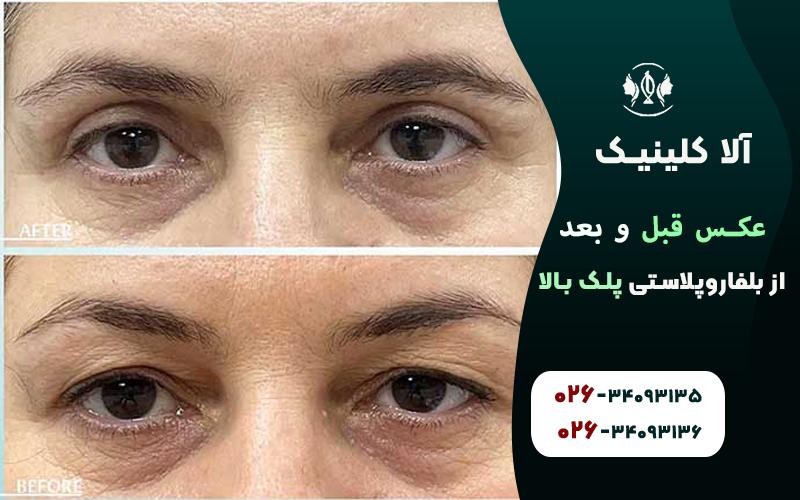 عکس قبل و بعد از بلفاروپلاستی پلک بالا