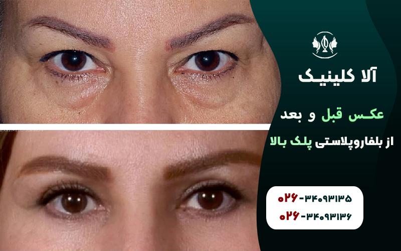 عکس قبل و بعد از بلفاروپلاستی پلک بالا