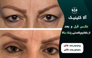 عکس قبل و بعد از بلفاروپلاستی پلک بالا