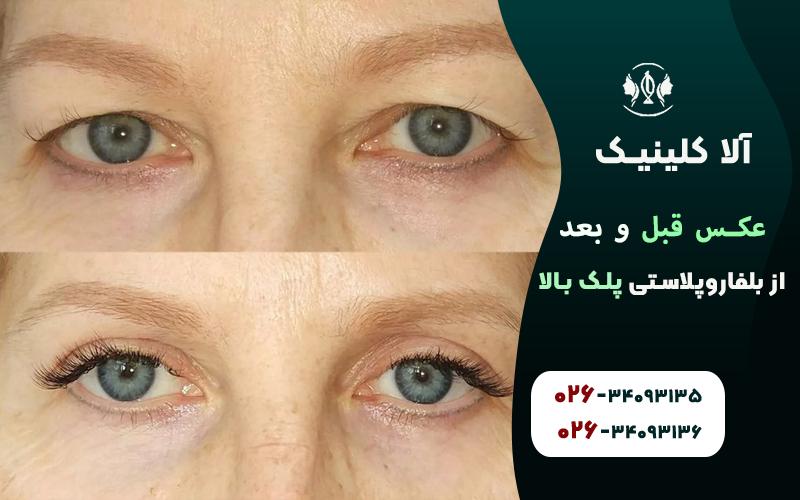 عکس قبل و بعد از بلفاروپلاستی پلک بالا