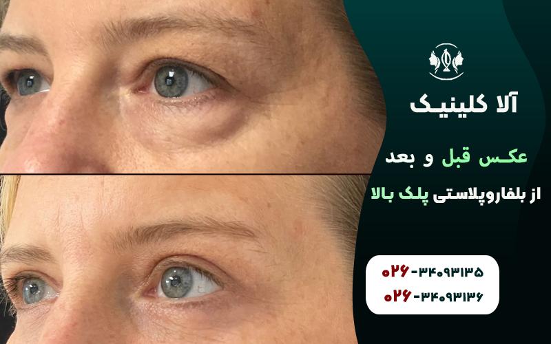 عکس قبل و بعد از بلفاروپلاستی پلک بالا
