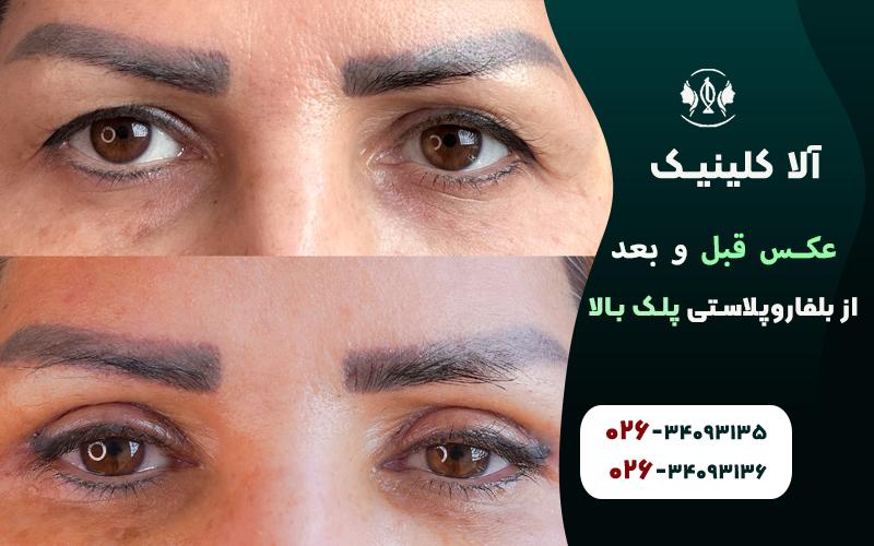 عکس قبل و بعد از بلفاروپلاستی پلک بالا