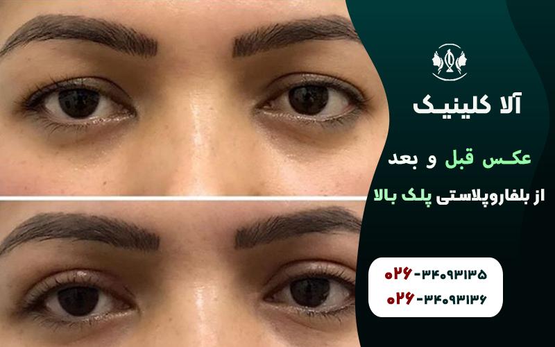 عکس قبل و بعد از بلفاروپلاستی پلک بالا