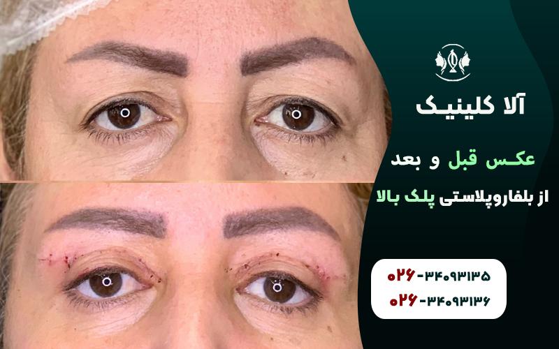 عکس قبل و بعد از بلفاروپلاستی پلک بالا