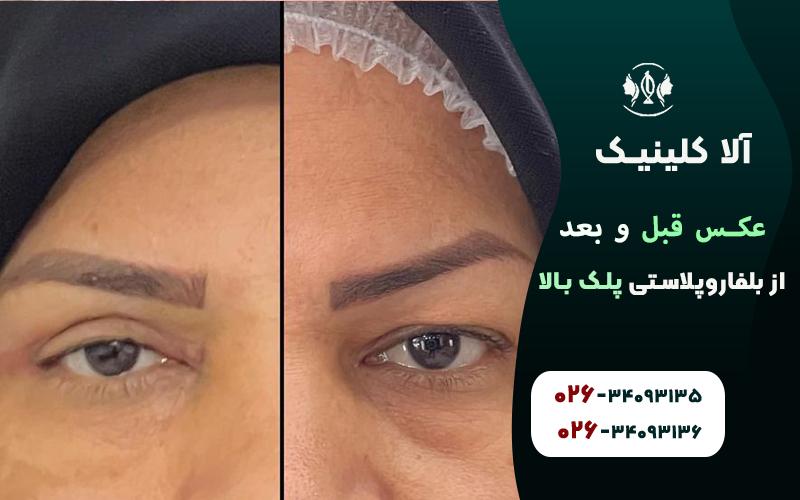 عکس قبل و بعد از بلفاروپلاستی پلک بالا
