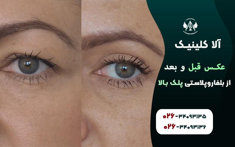 عکس قبل و بعد از بلفاروپلاستی پلک بالا