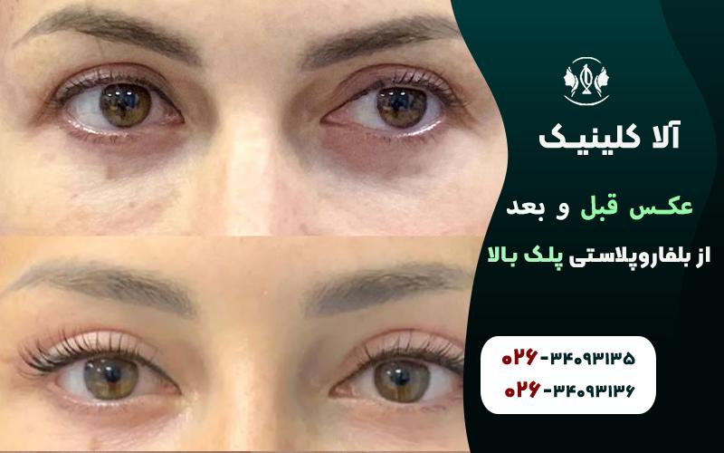 عکس قبل و بعد از بلفاروپلاستی پلک بالا