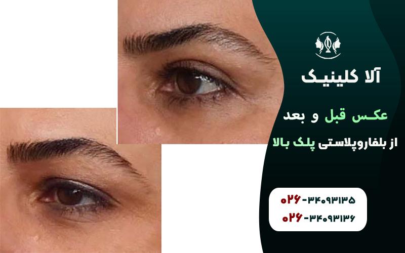 عکس قبل و بعد از بلفاروپلاستی پلک بالا