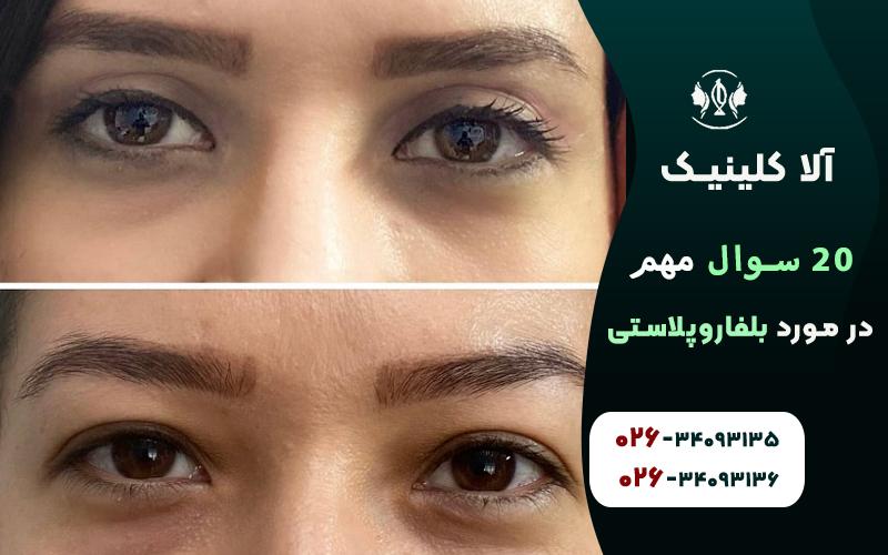 20 سوال مهم در مورد بلفاروپلاستی (جراحی پلک) + پاسخ
