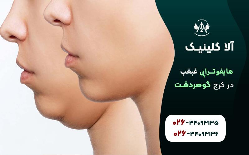 هایفوتراپی غبغب در کرج قبل و بعد