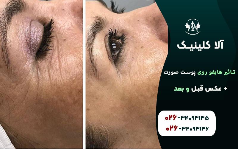 تاثیر هایفو روی پوست صورت + عکس قبل و بعد