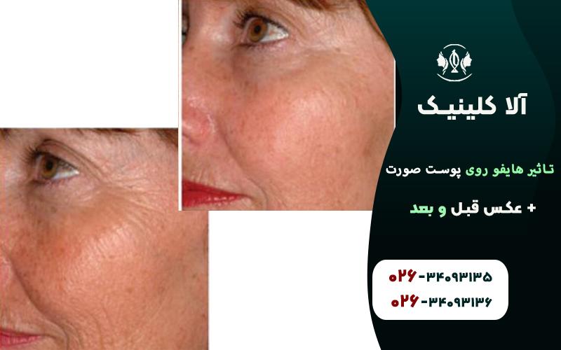 قبل و بعد از هایفو