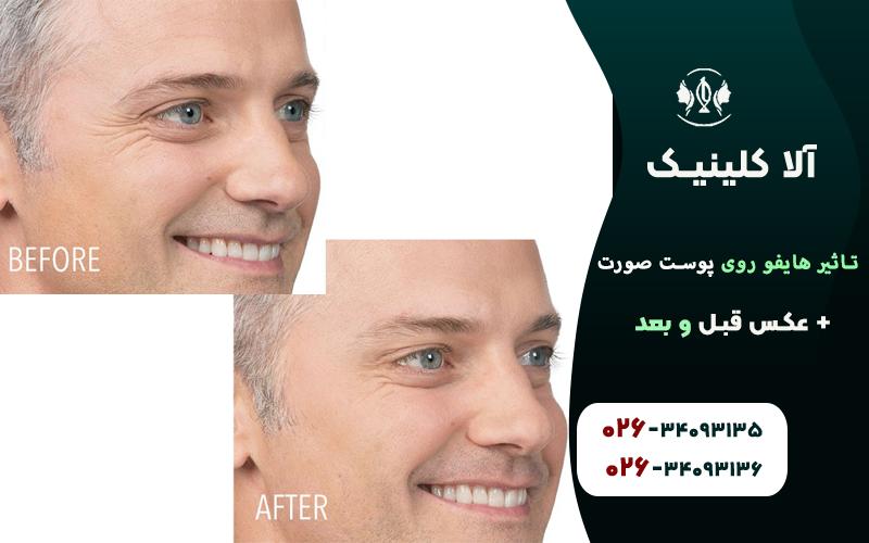 تاثیر هایفو روی پوست صورت + عکس قبل و بعد