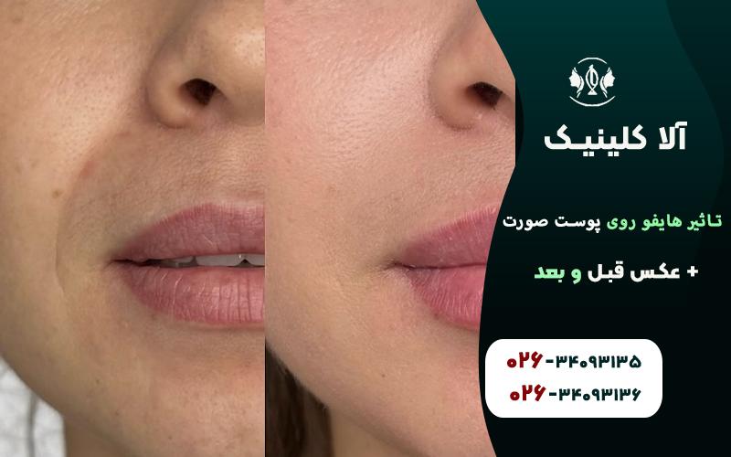 تاثیر هایفو روی پوست صورت + عکس قبل و بعد