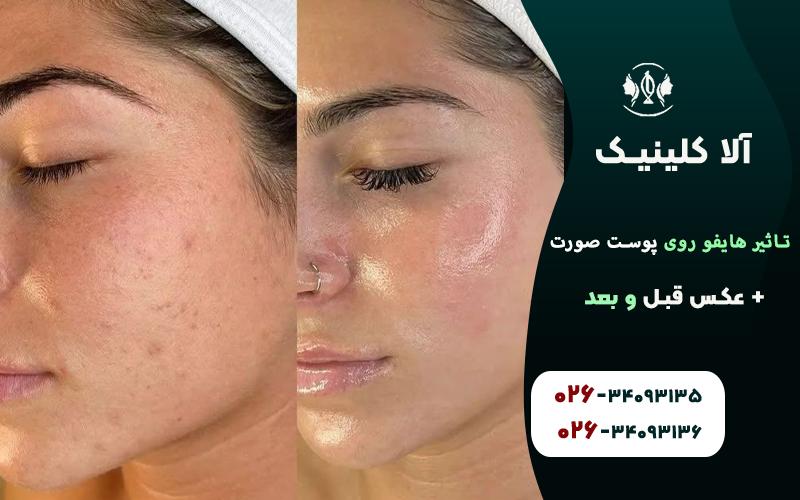 تاثیر هایفو روی پوست صورت + عکس قبل و بعد