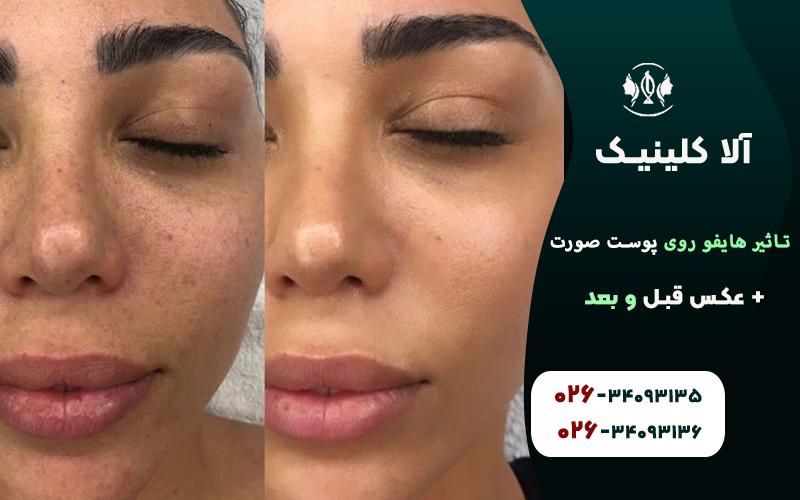 تاثیر هایفو روی پوست صورت + عکس قبل و بعد