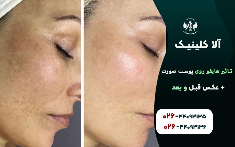 تاثیر هایفو روی پوست صورت + عکس قبل و بعد