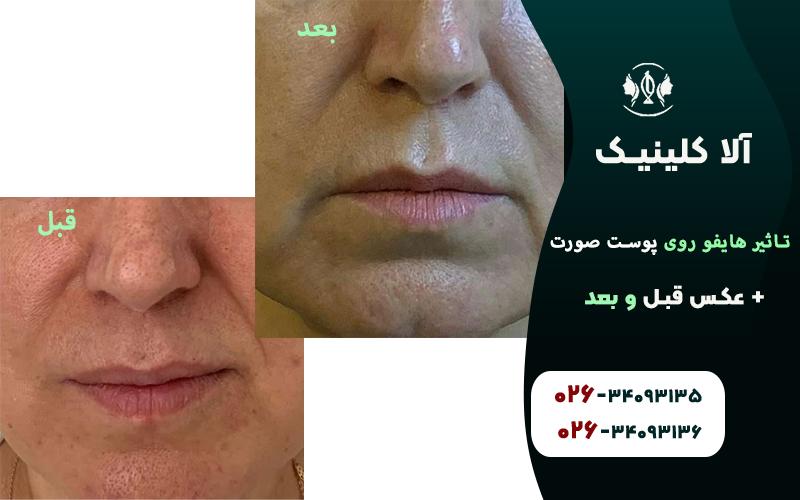 تاثیر هایفو روی پوست صورت + عکس قبل و بعد