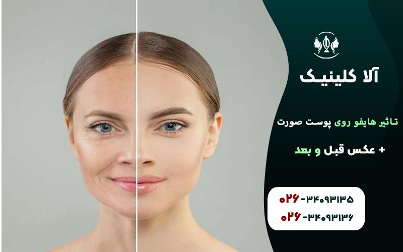 تاثیر هایفو روی پوست صورت + عکس قبل و بعد