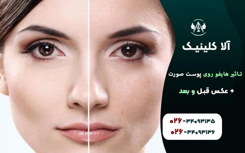 تاثیر هایفو روی پوست صورت + عکس قبل و بعد