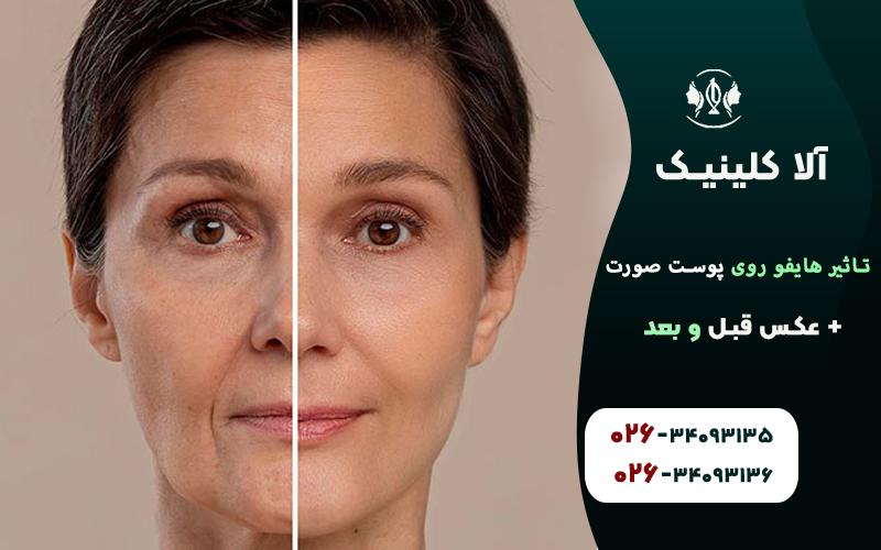 تاثیر هایفو روی پوست صورت + عکس قبل و بعد