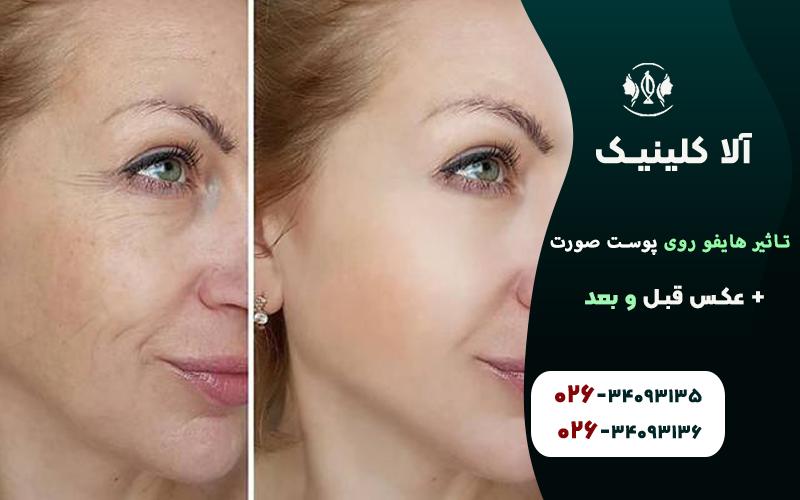 تاثیر هایفو روی پوست صورت + عکس قبل و بعد