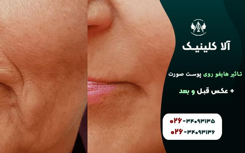 تاثیر هایفو روی پوست صورت + عکس قبل و بعد