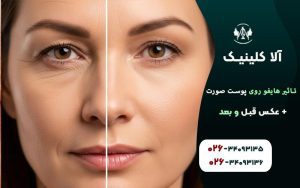 تاثیر هایفو روی پوست صورت + عکس قبل و بعد