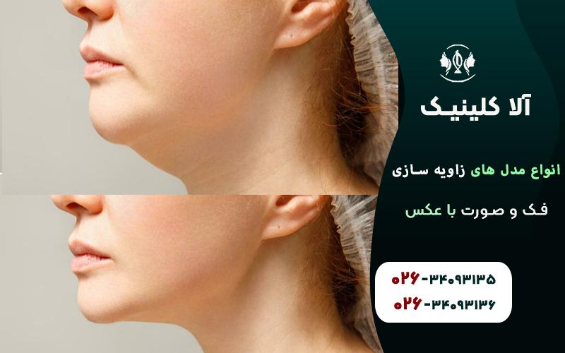 انواع مدل های زاویه سازی فک و صورت قبل و بعد