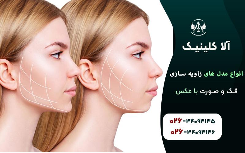 انواع مدل های زاویه سازی فک و صورت با عکس قبل و بعد