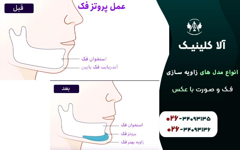 انواع مدل های زاویه سازی فک و صورت با عکس