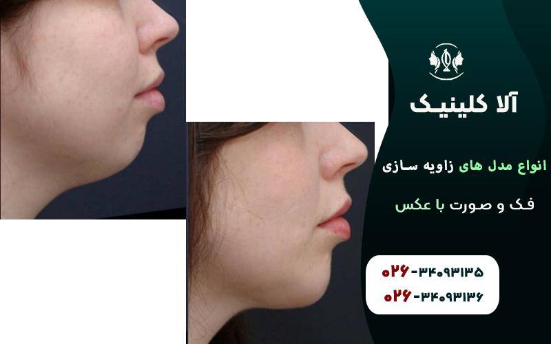 انواع مدل های زاویه سازی فک و صورت با عکس