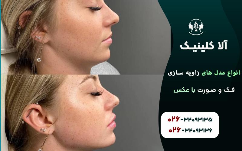 انواع مدل های زاویه سازی فک و صورت قبل و بعد