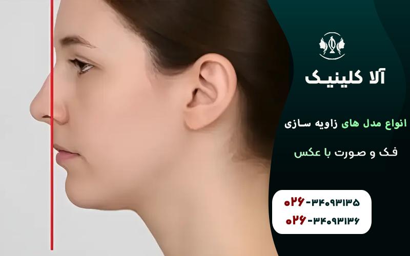 انواع مدل های زاویه سازی فک و صورت با عکس