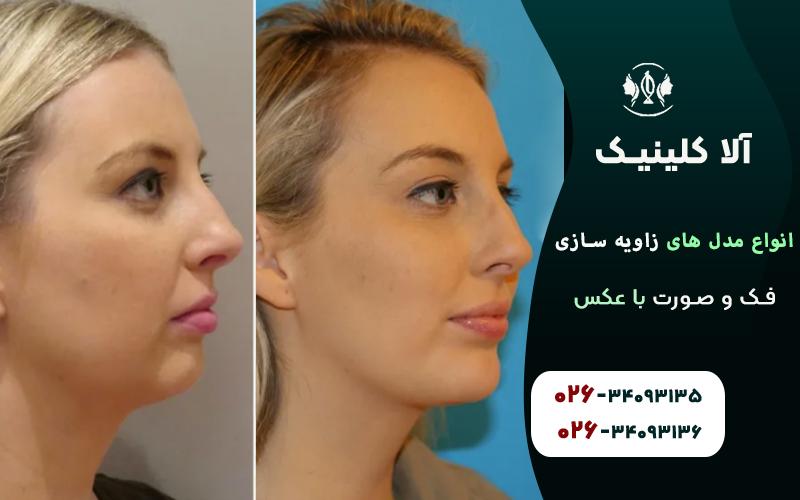 انواع مدل های زاویه سازی فک و صورت با عکس قبل و بعد