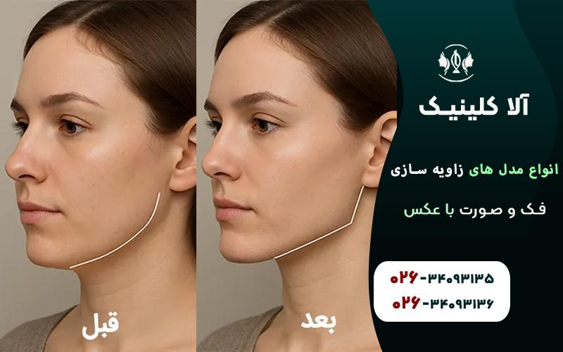 انواع مدل های زاویه سازی فک و صورت با عکس