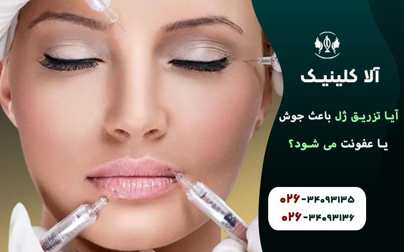 آیا تزریق ژل باعث جوش یا عفونت می شود!