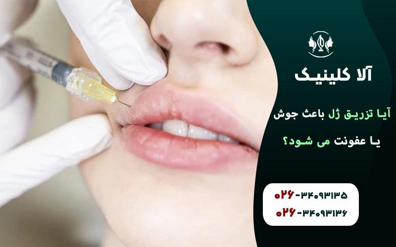 آیا تزریق ژل باعث جوش یا عفونت می شود!