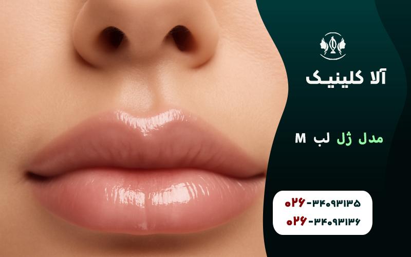 مدل تزریق ژل لب M