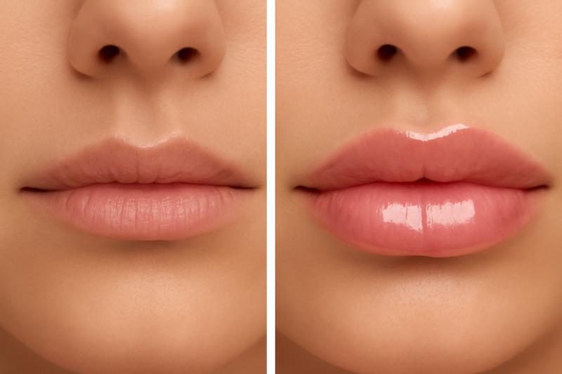 مدل ژل لب M قبل و بعد تزریق