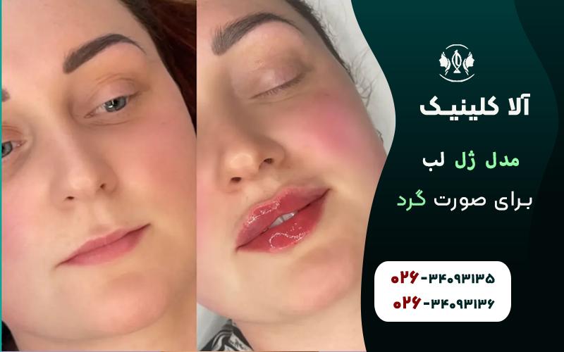 بهترین مدلهای ژل لب برای صورت گرد